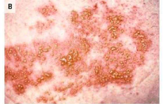 Captura de pantalla de una erupción de herpes zóster con grupos de ampollas. (CDC MMWR/captura de pantalla de The Epoch Times)
